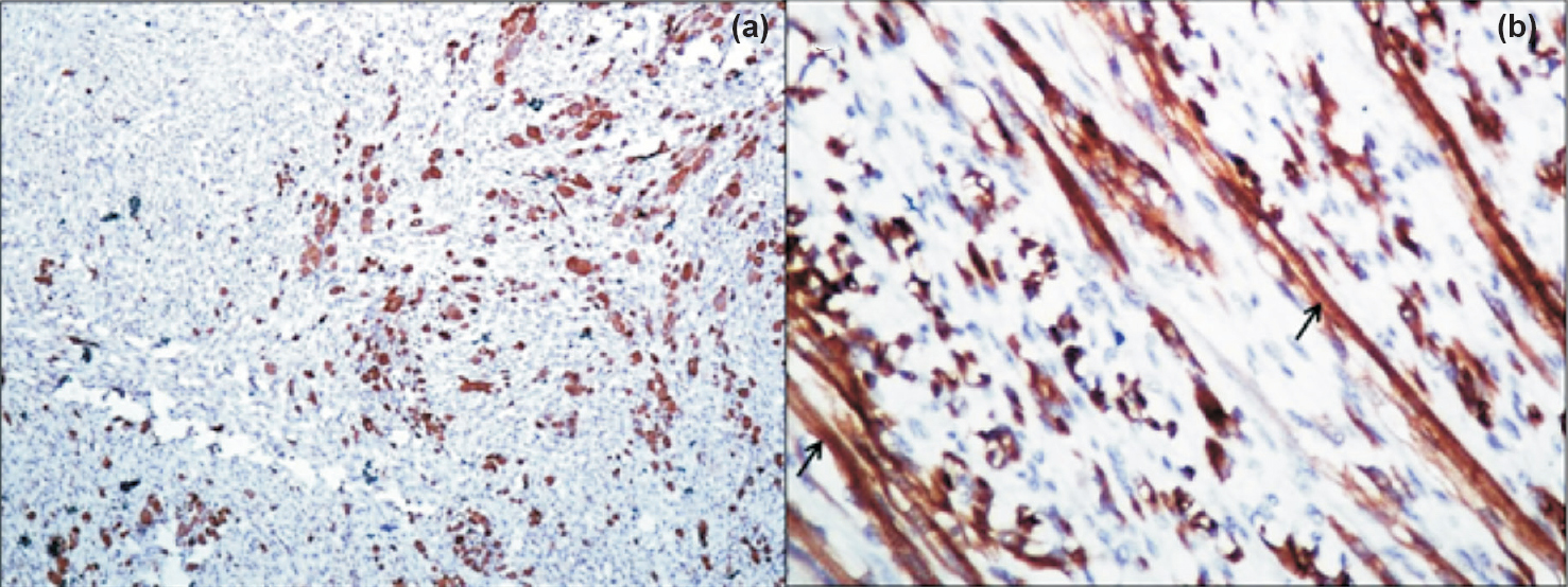 WT1 expression in second group of Wilms’ tumours showing heterologous stromal elements. (a) Strong cytoplasmic WT1 expression limited to rhabdomyoblastic stroma (Immunostain x100). (b) Higher magnification showed WT1 immunostaining in mature skeletal muscle fibres with cross-striations (arrows) (Immunostain x400).